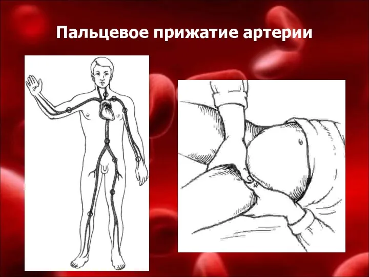 Пальцевое прижатие артерии