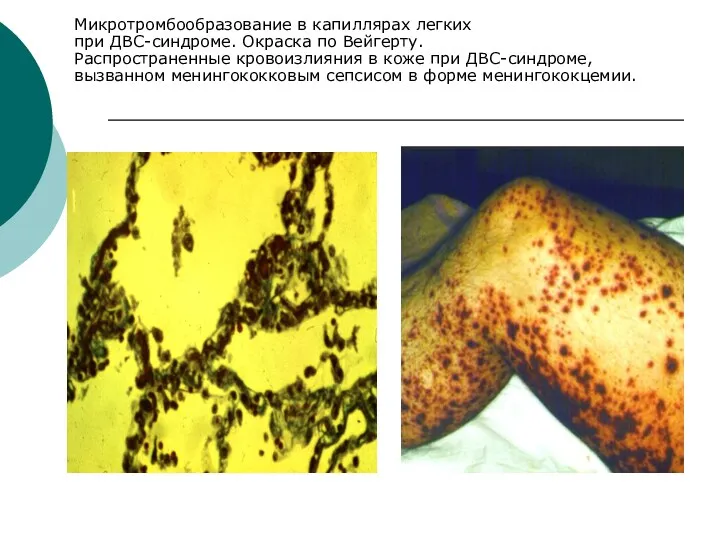 Микротромбообразование в капиллярах легких при ДВС-синдроме. Окраска по Вейгерту. Распространенные кровоизлияния в коже