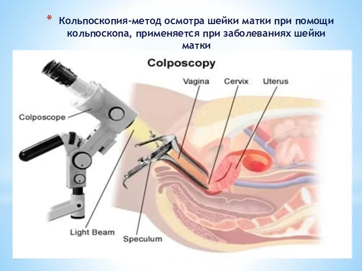 Кольпоскопия-метод осмотра шейки матки при помощи кольпоскопа, применяется при заболеваниях шейки матки