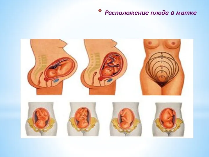 Расположение плода в матке