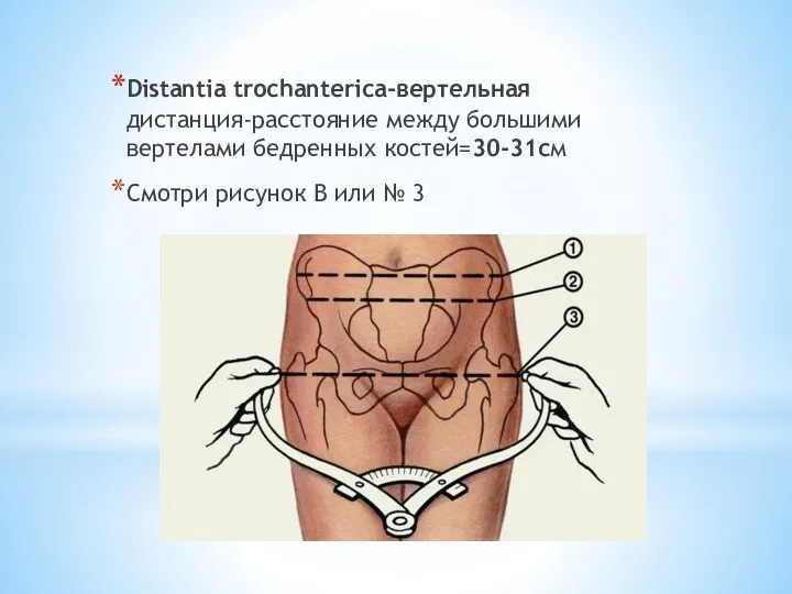 Distantia trochanterica-вертельная дистанция-расстояние между большими вертелами бедренных костей=30-31см Смотри рисунок В или № 3