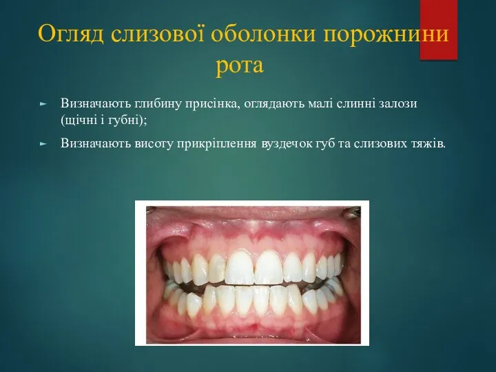 Огляд слизової оболонки порожнини рота Визначають глибину присінка, оглядають малі