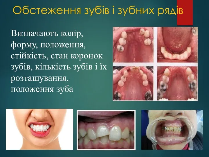 Обстеження зубів і зубних рядів Визначають колір, форму, положення, стійкість,