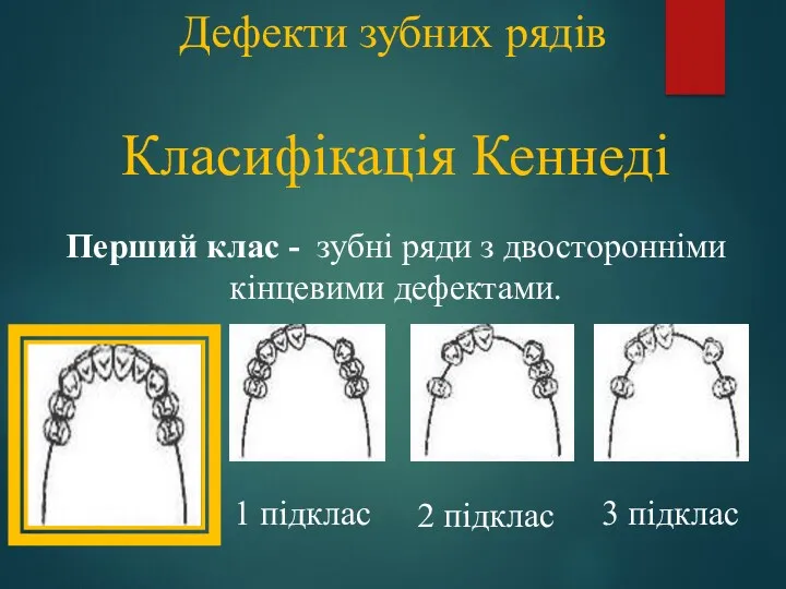 Дефекти зубних рядів Класифікація Кеннеді Перший клас - зубні ряди