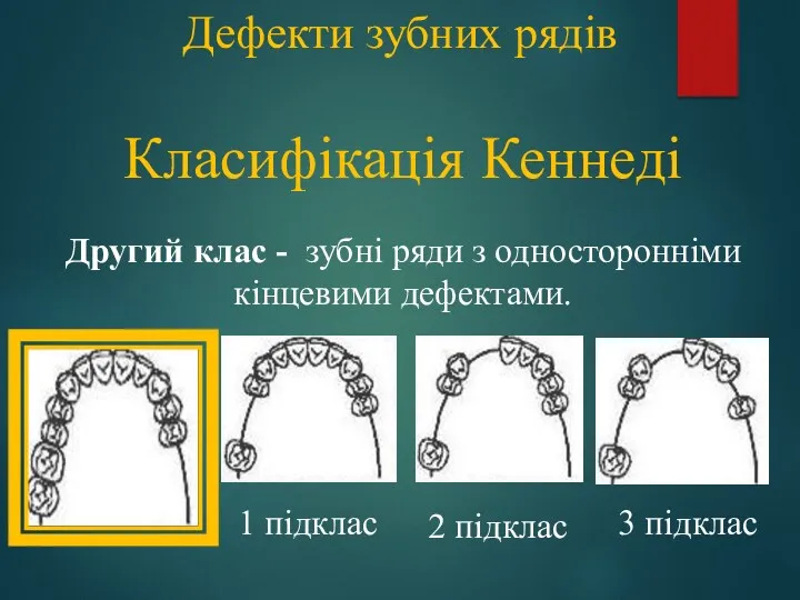 Дефекти зубних рядів Класифікація Кеннеді Другий клас - зубні ряди