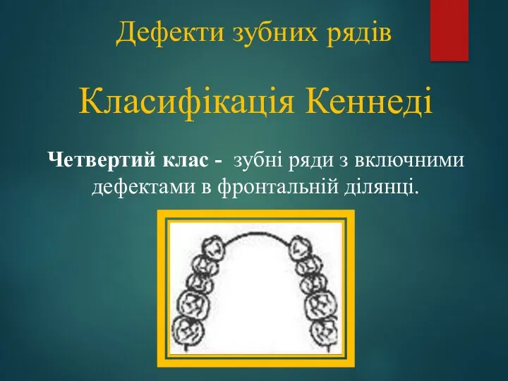 Дефекти зубних рядів Класифікація Кеннеді Четвертий клас - зубні ряди з включними дефектами в фронтальній ділянці.