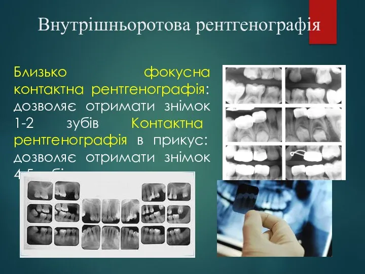 Внутрішньоротова рентгенографія Близько фокусна контактна рентгенографія: дозволяє отримати знімок 1-2