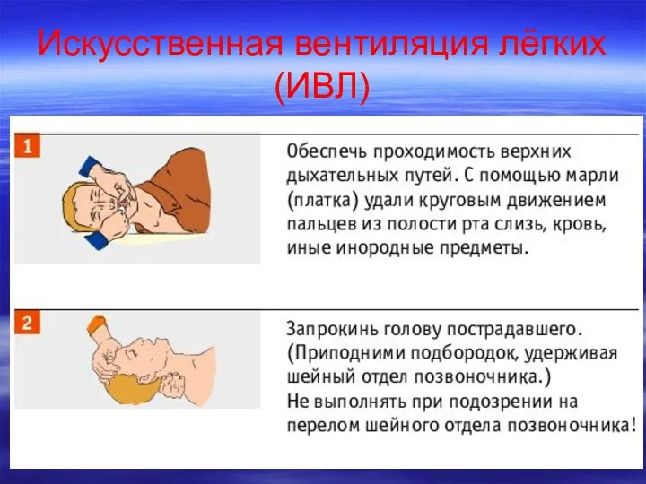 Искусственная вентиляция лёгких (ИВЛ)