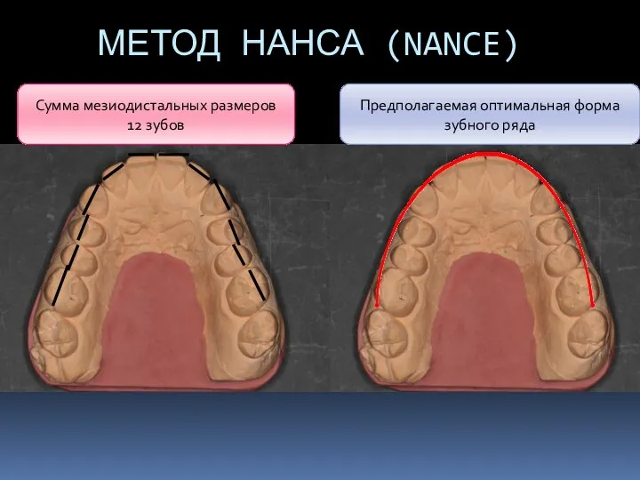 МЕТОД НАНСА (NANCE) Сумма мезиодистальных размеров 12 зубов Предполагаемая оптимальная форма зубного ряда