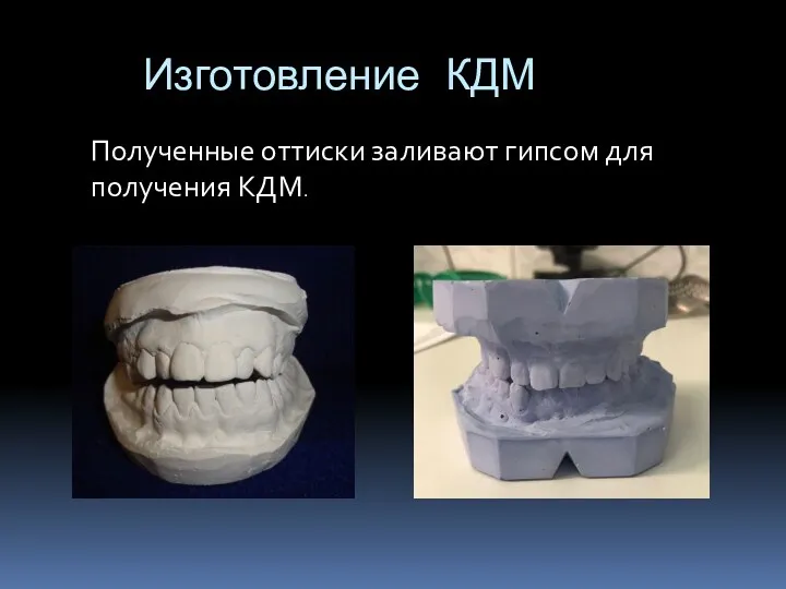 Изготовление КДМ Полученные оттиски заливают гипсом для получения КДМ.