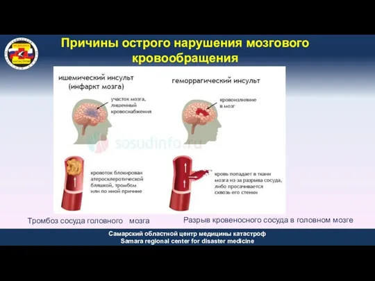 Причины острого нарушения мозгового кровообращения Разрыв кровеносного сосуда в головном мозге Тромбоз сосуда головного мозга