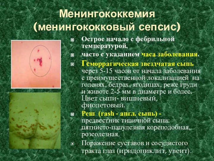 Менингококкемия (менингококковый сепсис) Острое начало с фебрильной температурой, часто с