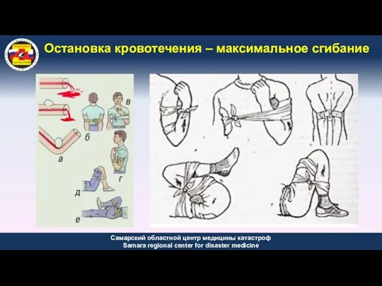 Остановка кровотечения – максимальное сгибание