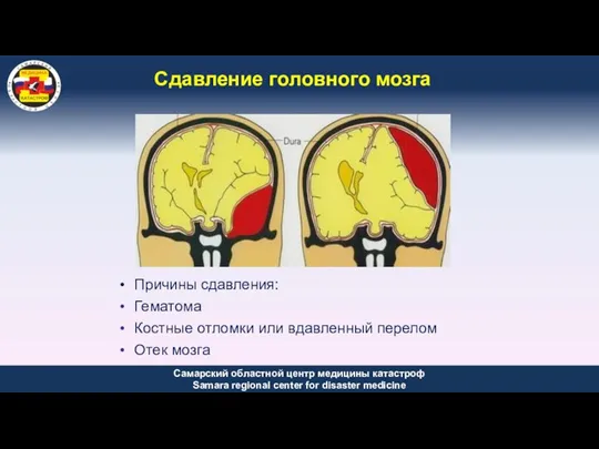 Сдавление головного мозга Причины сдавления: Гематома Костные отломки или вдавленный перелом Отек мозга