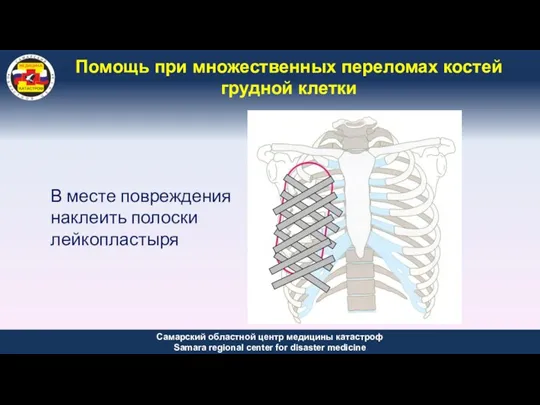 Помощь при множественных переломах костей грудной клетки В месте повреждения наклеить полоски лейкопластыря