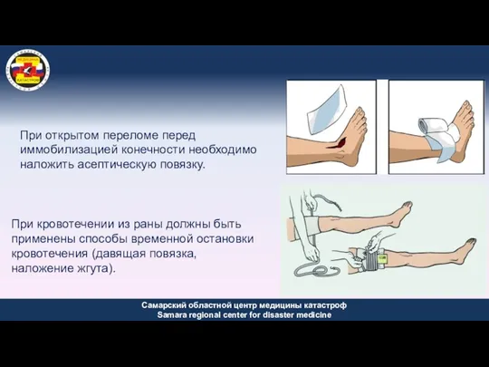 При открытом переломе перед иммобилизацией конечности необходимо наложить асептическую повязку.