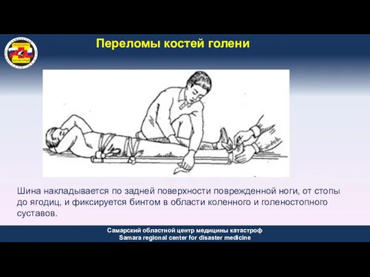 Переломы костей голени Шина накладывается по задней поверхности поврежденной ноги,