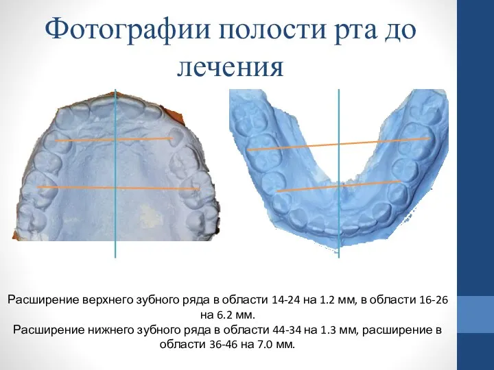 Расширение верхнего зубного ряда в области 14-24 на 1.2 мм,