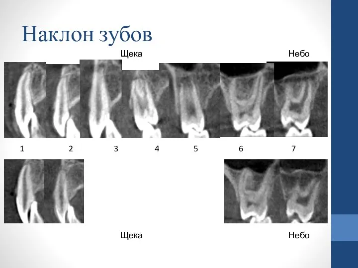 Наклон зубов 1 2 3 4 5 6 7 Щека Небо Щека Небо