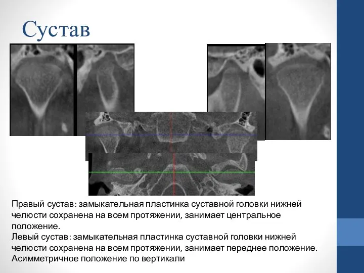 Сустав Правый сустав: замыкательная пластинка суставной головки нижней челюсти сохранена