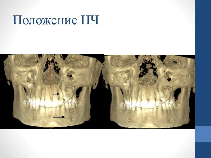 Положение НЧ