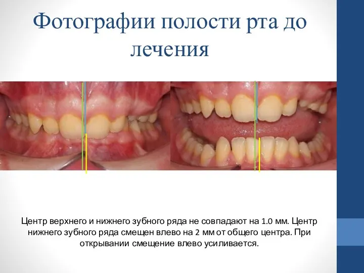 Центр верхнего и нижнего зубного ряда не совпадают на 1.0