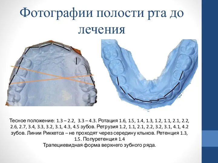 Фотографии полости рта до лечения Тесное положение: 1.3 – 2.2,