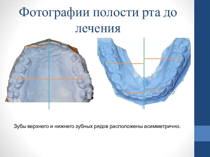 Зубы верхнего и нижнего зубных рядов расположены асимметрично. Фотографии полости рта до лечения