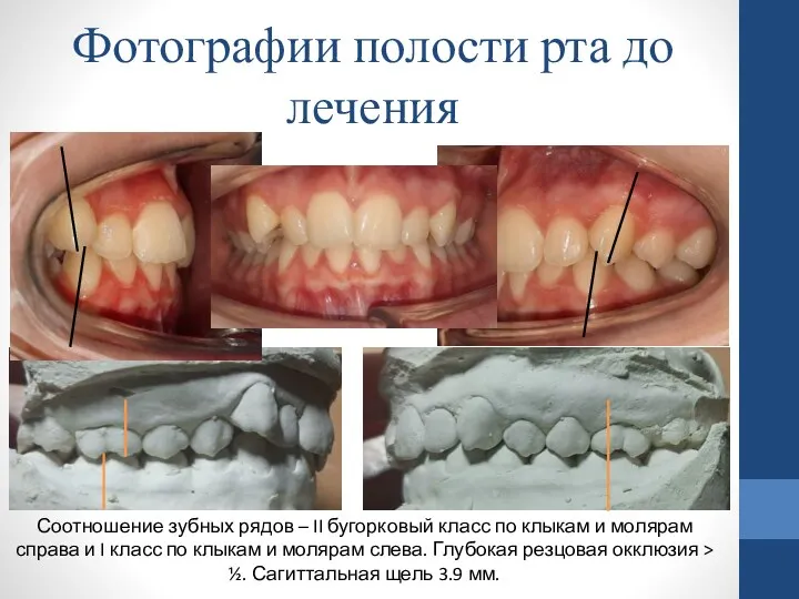 Соотношение зубных рядов – II бугорковый класс по клыкам и