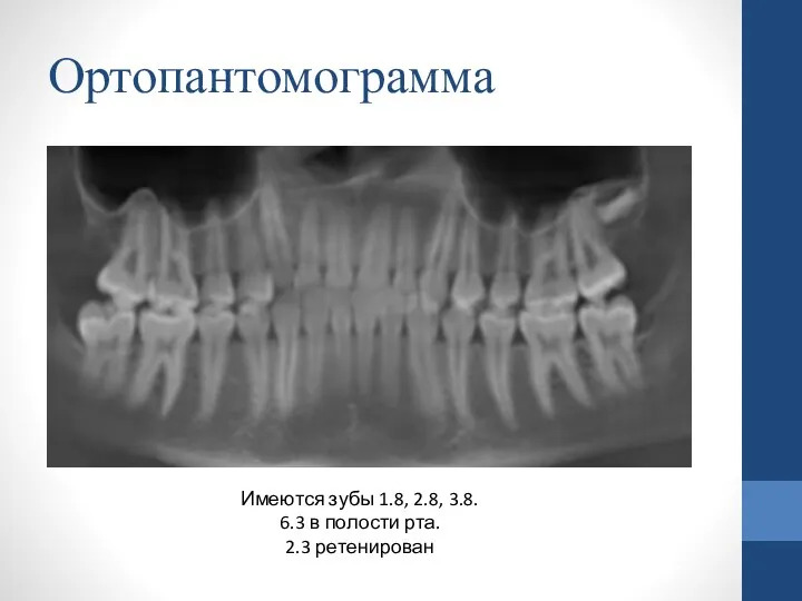Ортопантомограмма Имеются зубы 1.8, 2.8, 3.8. 6.3 в полости рта. 2.3 ретенирован