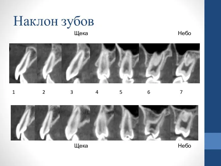 Наклон зубов 1 2 3 4 5 6 7 Щека Небо Щека Небо