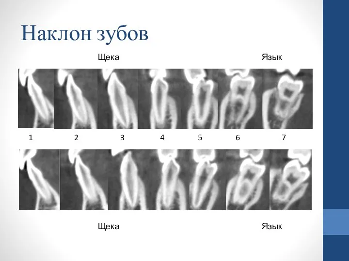 1 2 3 4 5 6 7 Наклон зубов Щека Язык Щека Язык