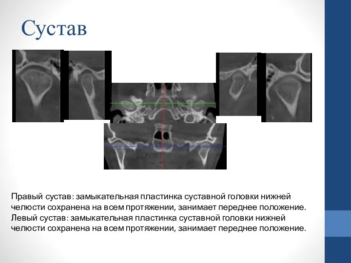 Сустав Правый сустав: замыкательная пластинка суставной головки нижней челюсти сохранена