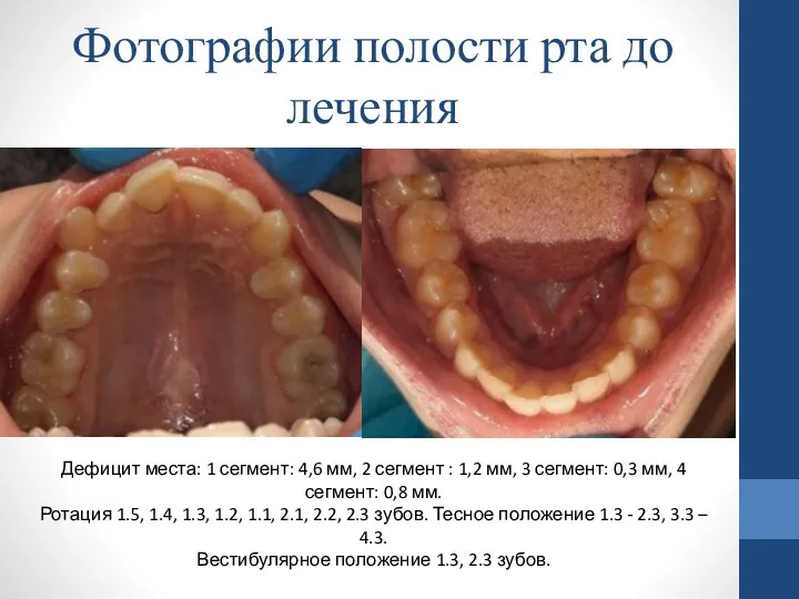 Фотографии полости рта до лечения Дефицит места: 1 сегмент: 4,6