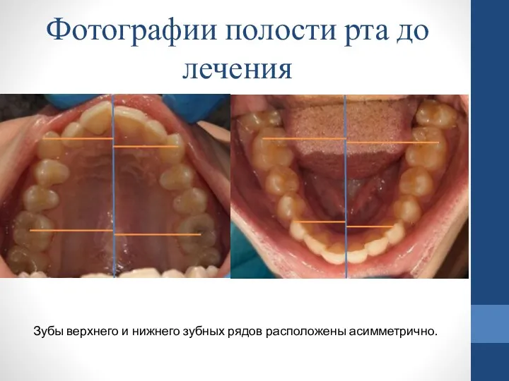 Зубы верхнего и нижнего зубных рядов расположены асимметрично. Фотографии полости рта до лечения