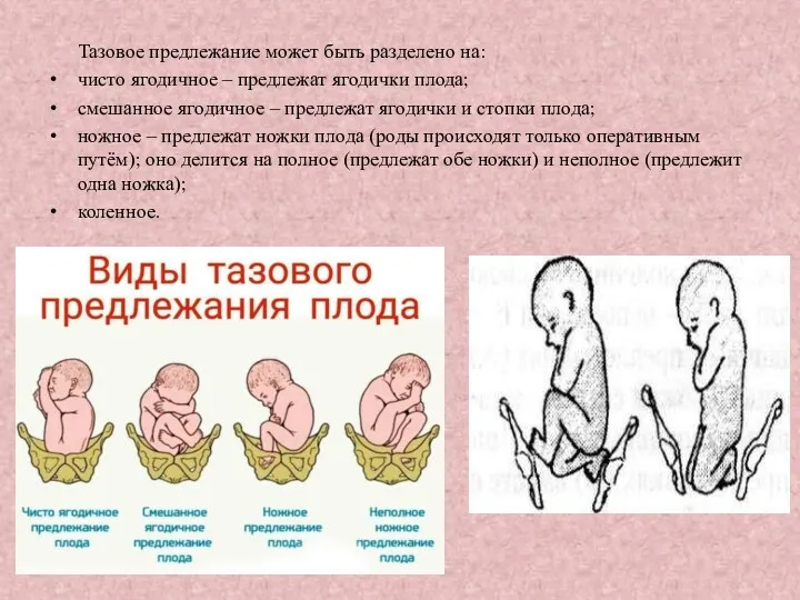 Тазовое предлежание может быть разделено на: чисто ягодичное – предлежат