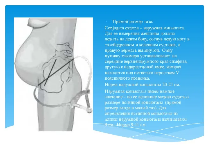 Прямой размер таза: Conjugata externa – наружная коньюгата. Для ее