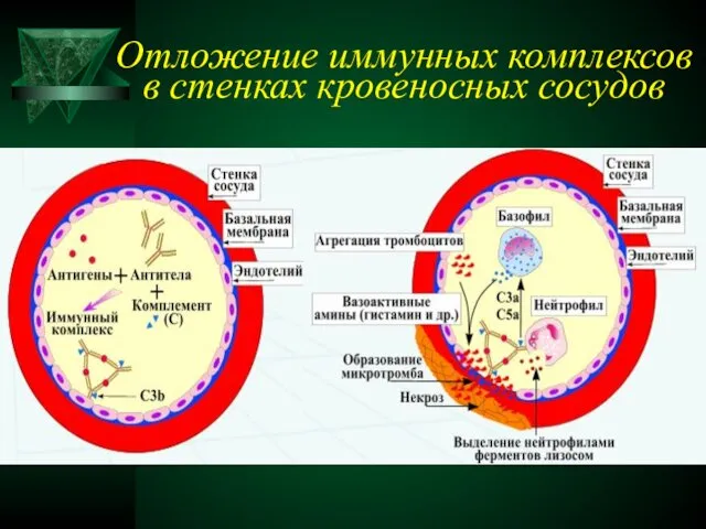 Отложение иммунных комплексов в стенках кровеносных сосудов