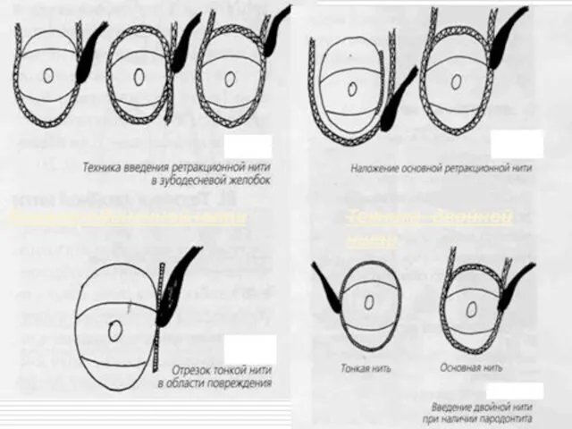 Техника одиночной нити Техника избирательной двойной нити Техника двойной нити