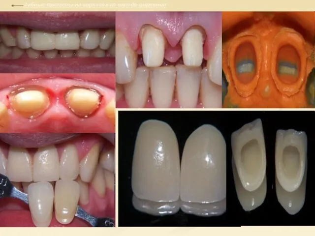 Зубные протезы на каркасах из оксида циркония
