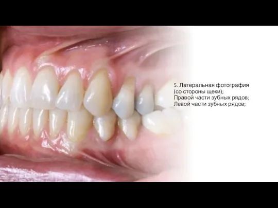 5. Латеральная фотография (со стороны щеки); Правой части зубных рядов; Левой части зубных рядов;