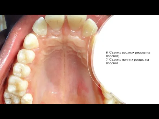 6. Съемка верхних резцов на просвет; 7. Съемка нижних резцов на просвет.