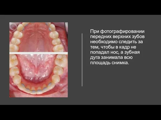 При фотографировании передних верхних зубов необходимо следить за тем, чтобы