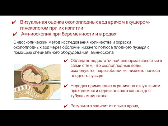 Амниоскопия при беременности и в родах: Эндоскопический метод исследования количества