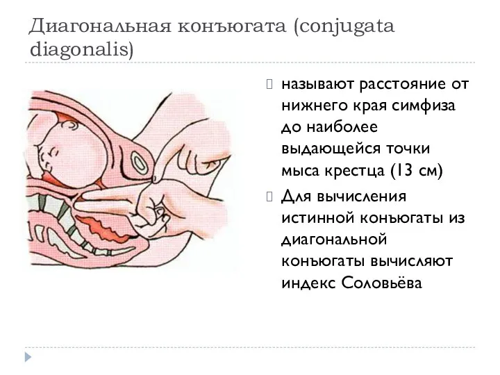 Диагональная конъюгата (conjugata diagonalis) называют расстояние от нижнего края симфиза