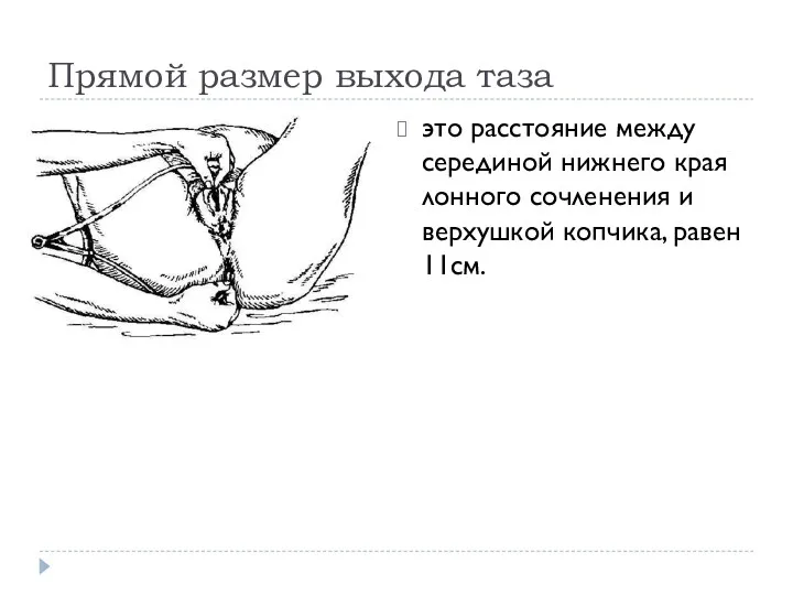 Прямой размер выхода таза это расстояние между серединой нижнего края