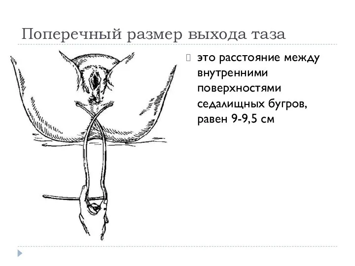 Поперечный размер выхода таза это расстояние между внутренними поверхностями седалищных бугров, равен 9-9,5 см