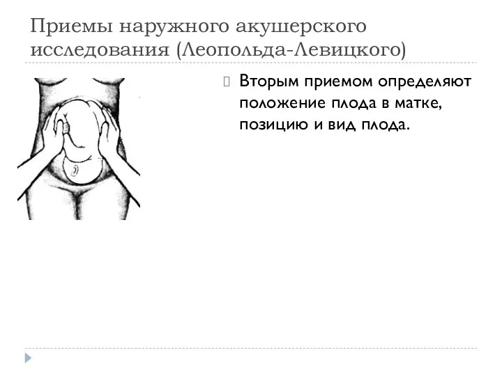 Приемы наружного акушерского исследования (Леопольда-Левицкого) Вторым приемом определяют положение плода в матке, позицию и вид плода.