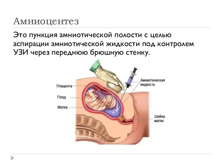 Амниоцентез Это пункция амниотической полости с целью аспирации амниотической жидкости