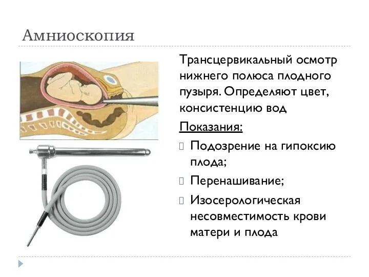 Амниоскопия Трансцервикальный осмотр нижнего полюса плодного пузыря. Определяют цвет, консистенцию